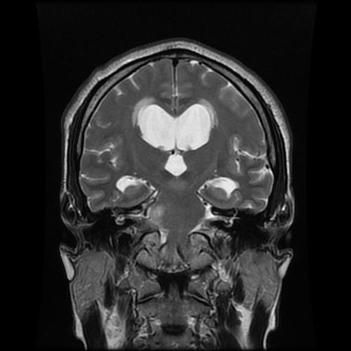 File:Cerebellar hemangioblastoma (Radiopaedia 88055-104622 Coronal T2 8).jpg