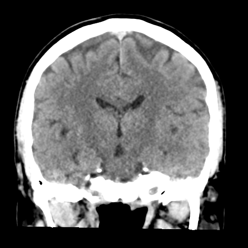 File:Cerebellar hemorrhage (Radiopaedia 37000-38669 Coronal non-contrast 25).png