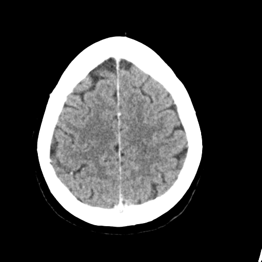 File:Cerebellar metastasis (Radiopaedia 54578-60812 Axial C+ 40).png