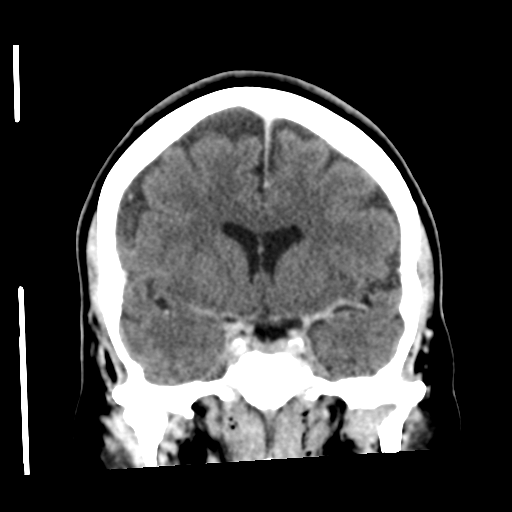 Cerebellar metastasis (cystic appearance) (Radiopaedia 41395-44258 D 27).png