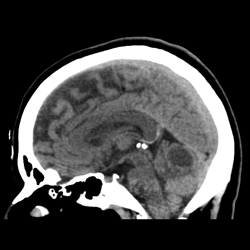 File:Cerebellar metastasis (cystic appearance) (Radiopaedia 41395-44258 E 29).png