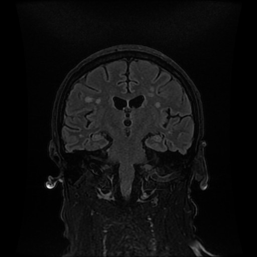 File:Cerebellar metastasis of pulmonary adenocarcinoma, cavernous venous malformation, and developmental venous anomaly (Radiopaedia 85827-101661 Coronal FLAIR 19).jpg