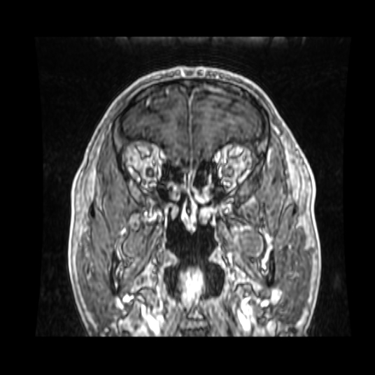 Cerebellar metastasis of pulmonary adenocarcinoma, cavernous venous malformation, and developmental venous anomaly (Radiopaedia 85827-101661 Coronal T1 C+ 76).jpg