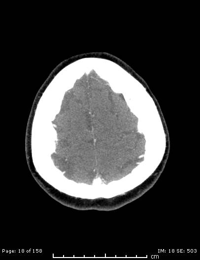 Cerebellar strokes due to intracranial giant cell arteritis (Radiopaedia 68799-78510 CT angiogram 18).jpg