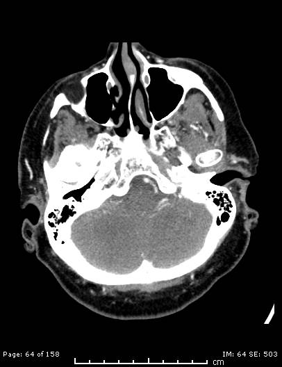 File:Cerebellar strokes due to intracranial giant cell arteritis (Radiopaedia 68799-78510 CT angiogram 64).jpg