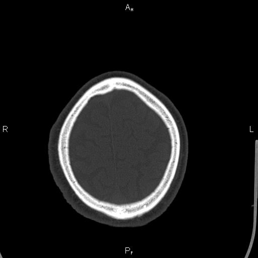 Cerebellopontine angle arachnoid cyst (Radiopaedia 85149-100704 Axial bone window 46).jpg