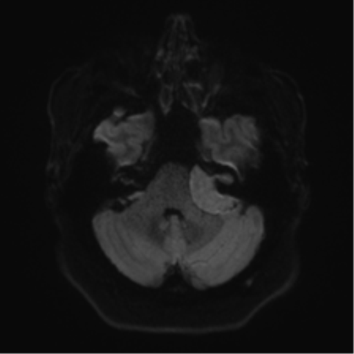 Cerebellopontine angle meningioma (Radiopaedia 48434-53348 Axial DWI 45).png