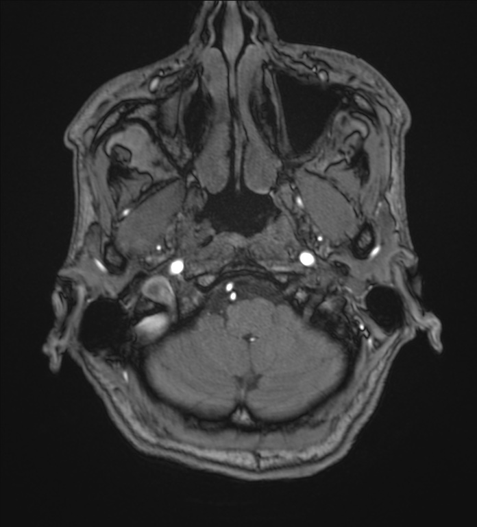 Cerebellopontine angle meningioma (Radiopaedia 72983-83680 Axial MRA 7).jpg