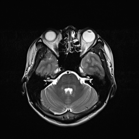 Cerebral abscess (Radiopaedia 24212-24478 Axial T2 21).jpg