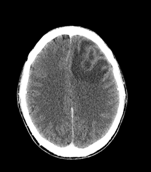 Cerebral abscess (Radiopaedia 57774-64741 Axial C+ delayed 43).png