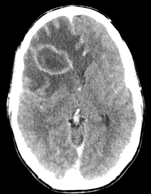 Cerebral abscess (Radiopaedia 60342-68008 Axial C+ delayed 25).png