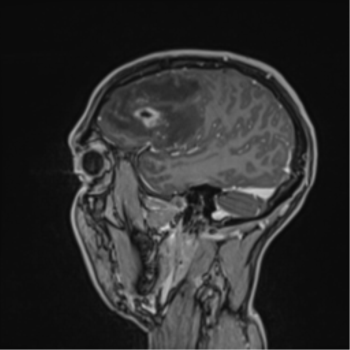 Cerebral abscess (Radiopaedia 60342-68009 J 44).png