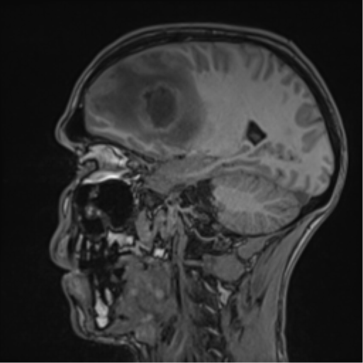 Cerebral abscess (Radiopaedia 60342-68009 Sagittal T1 36).png