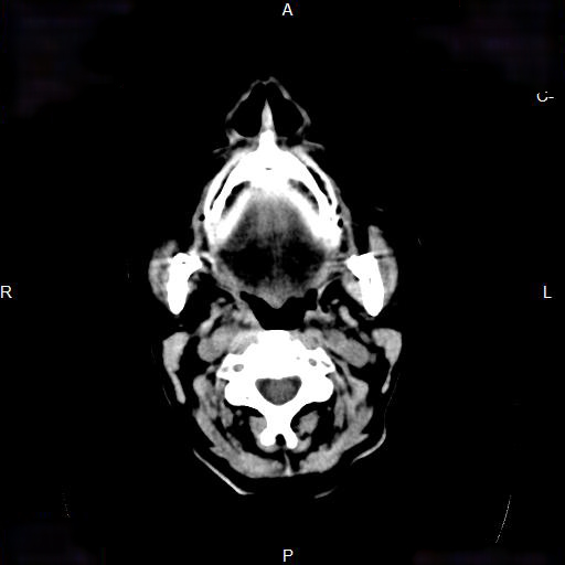 File:Cerebral abscess (Radiopaedia 7606-8431 Axial non-contrast 1).jpg