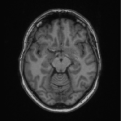 Cerebral abscess from pulmonary arteriovenous malformation (Radiopaedia 86275-102291 Axial T1 32).png