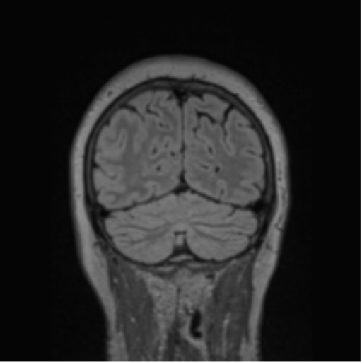 Cerebral abscess from pulmonary arteriovenous malformation (Radiopaedia 86275-102291 Coronal FLAIR 21).png