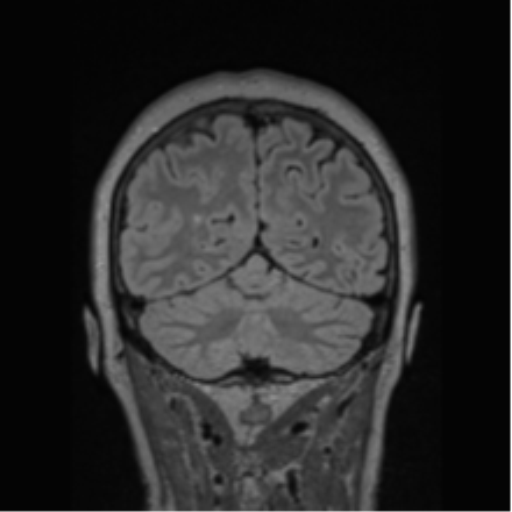Cerebral abscess from pulmonary arteriovenous malformation (Radiopaedia 86275-102291 Coronal FLAIR 25).png