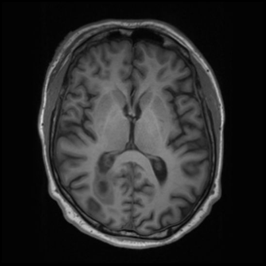File:Cerebral abscess with ventriculitis (Radiopaedia 78965-91878 Axial T1 26).jpg