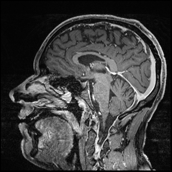 Cerebral abscess with ventriculitis (Radiopaedia 78965-91878 Sagittal T1 C+ 88).jpg