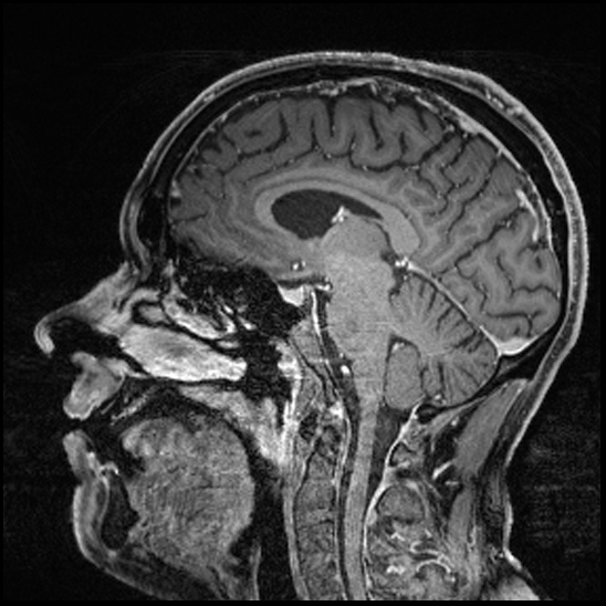 Cerebral abscess with ventriculitis (Radiopaedia 78965-91878 Sagittal T1 C+ 98).jpg