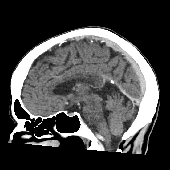 Cerebral amyloid angiopathy-related inflammation (Radiopaedia 74836-85848 C 32).jpg