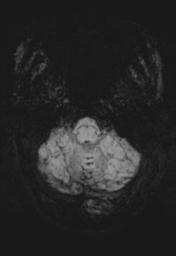 File:Cerebral amyloid angiopathy (Radiopaedia 29129-29518 Axial SWI MIP 5).jpg