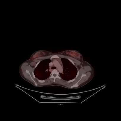 Cerebral and abdominal tuberculosis (Radiopaedia 90499-107853 C 89).jpg