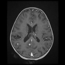 Cerebral and spinal tuberculosis (Radiopaedia 90489-107837 Axial T1 C+ 121).jpg