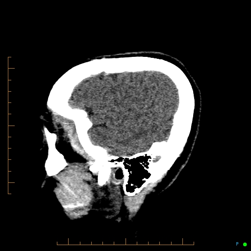 Cerebral arteriovenous malformation (AVM) (Radiopaedia 78162-90706 A 66).jpg
