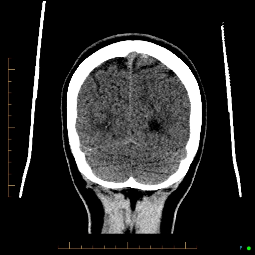 Cerebral arteriovenous malformation (AVM) (Radiopaedia 78162-90706 Coronal non-contrast 82).jpg