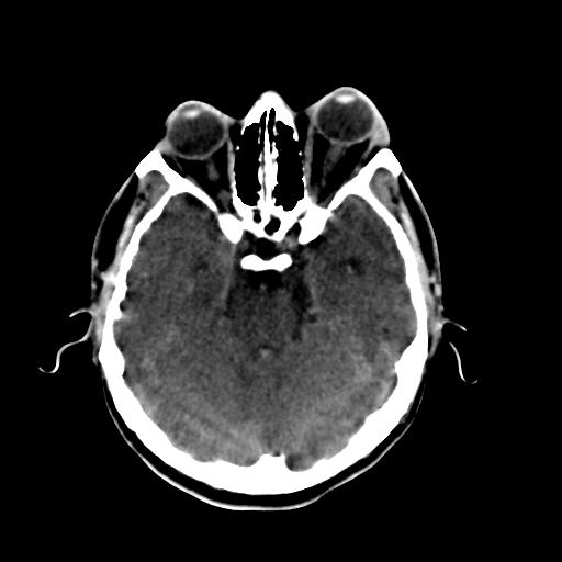 Cerebral arteriovenous malformation (Radiopaedia 28518-28759 Axial non-contrast 23).jpg