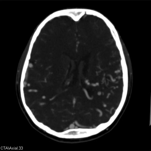 File:Cerebral arteriovenous malformation (Radiopaedia 28518-28759 B 33).jpg