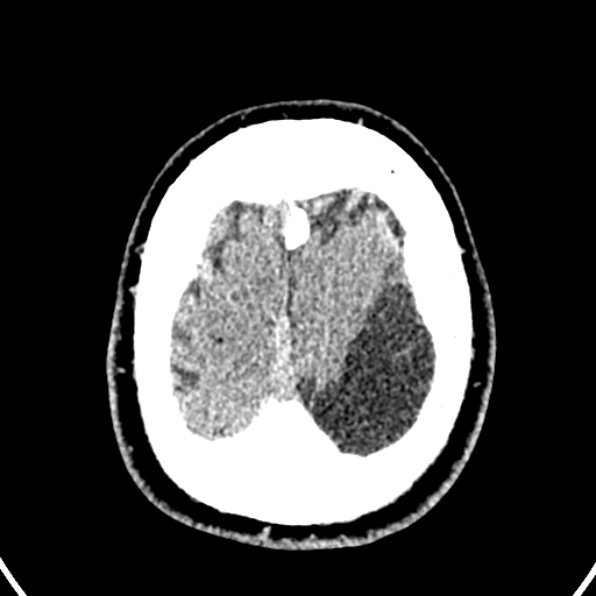 File:Cerebral arteriovenous malformation (Radiopaedia 37182-39012 Axial non-contrast 43).jpg