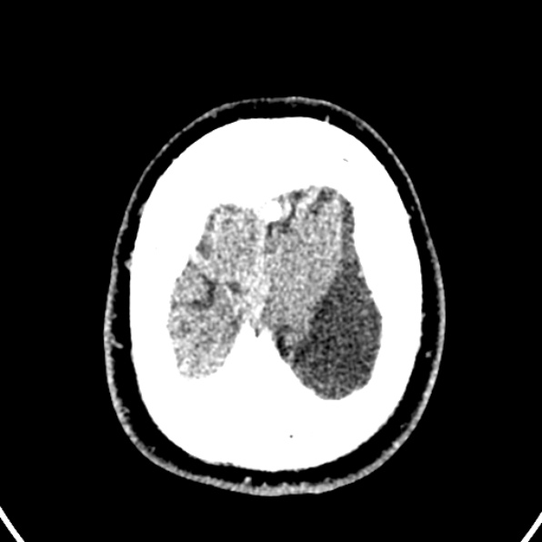 Cerebral arteriovenous malformation (Radiopaedia 37182-39012 Axial non-contrast 44).jpg