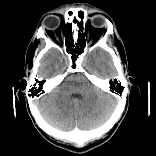 File:Cerebral arteriovenous malformation (Radiopaedia 55798-62371 Axial non-contrast 17).png