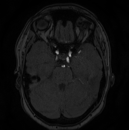 Cerebral arteriovenous malformation (Radiopaedia 74411-85654 Axial MRA 36).jpg