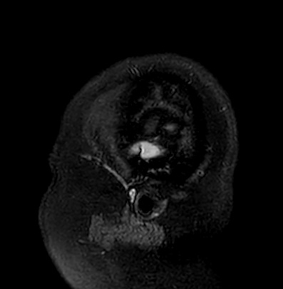Cerebral arteriovenous malformation (Radiopaedia 74411-85746 Sagittal FLAIR 1).jpg