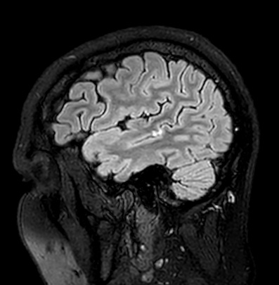Cerebral arteriovenous malformation (Radiopaedia 74411-85746 Sagittal FLAIR 17).jpg