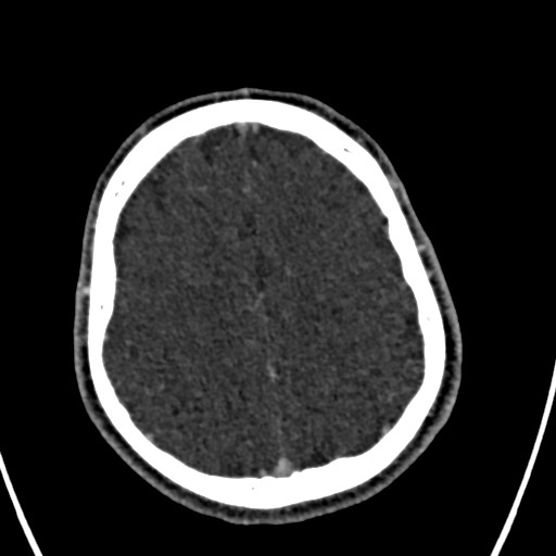 Cerebral arteriovenous malformation (Radiopaedia 78188-90746 Axial C+ delayed 134).jpg