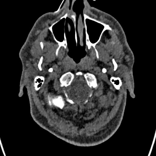 Cerebral arteriovenous malformation (Radiopaedia 78188-90746 Axial non-contrast 11).jpg