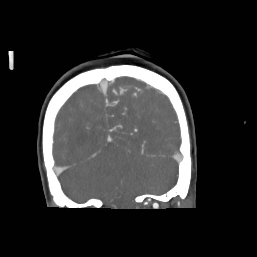 File:Cerebral arteriovenous malformation (Radiopaedia 79677-92888 B 39).jpg