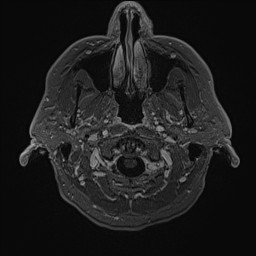 File:Cerebral arteriovenous malformation (Radiopaedia 84015-99245 Axial T1 C+ 13).jpg