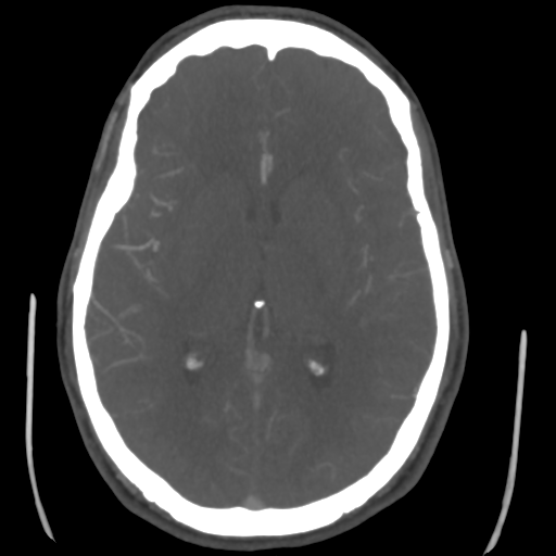 Cerebral arteriovenous malformation (Spetzler-Martin grade 2) (Radiopaedia 41262-44076 E 28).png
