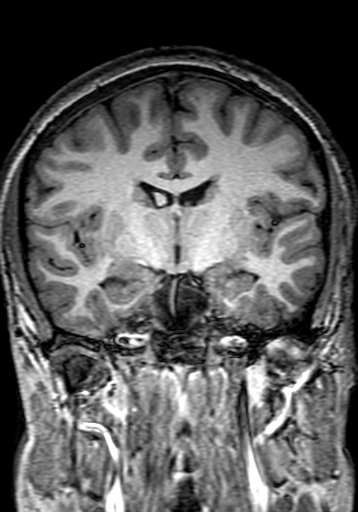 File:Cerebral arteriovenous malformation at posterior body of corpus callosum (Radiopaedia 74111-84925 Coronal T1 155).jpg