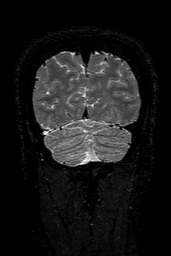 Cerebral arteriovenous malformation at posterior body of corpus callosum (Radiopaedia 74111-84925 Coronal T2 156).jpg