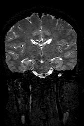 Cerebral arteriovenous malformation at posterior body of corpus callosum (Radiopaedia 74111-84925 Coronal T2 95).jpg