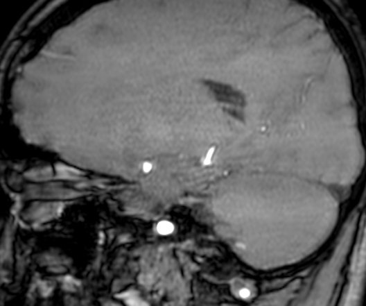 Cerebral arteriovenous malformation at posterior body of corpus callosum (Radiopaedia 74111-84925 J 251).jpg
