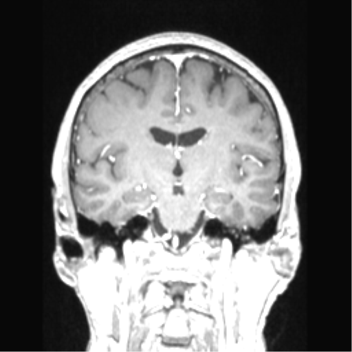 Cerebral arteriovenous malformation with hemorrhage (Radiopaedia 34422-35737 Coronal T1 C+ 47).png
