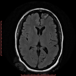 File:Cerebral cavernous malformation (Radiopaedia 26177-26306 FLAIR 12).jpg