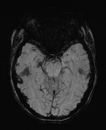 Cerebral cavernous venous malformation (Radiopaedia 70008-80021 Axial SWI 25).jpg
